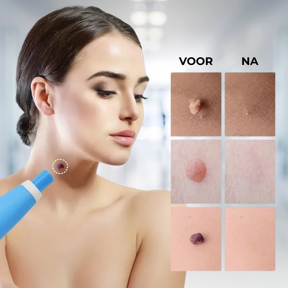 ClearSkin™ Skin Tag Remover